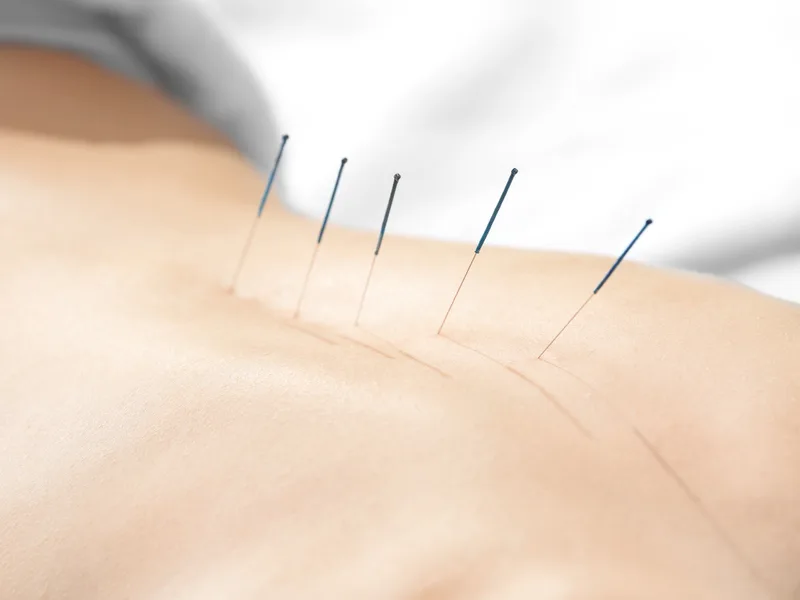 Acupuncture at New Beginnings Chiropractic in Hudsonville