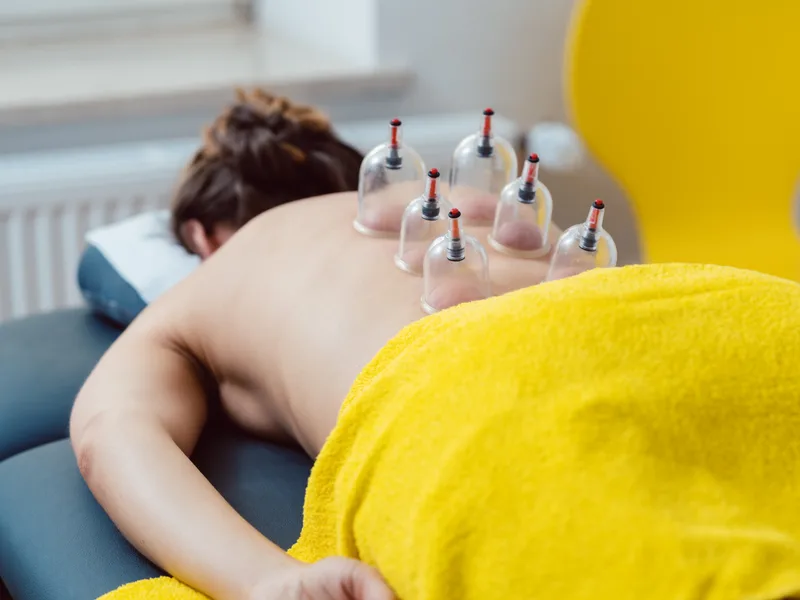 Cupping Therapy at New Beginnings Chiropractic in Hudsonville