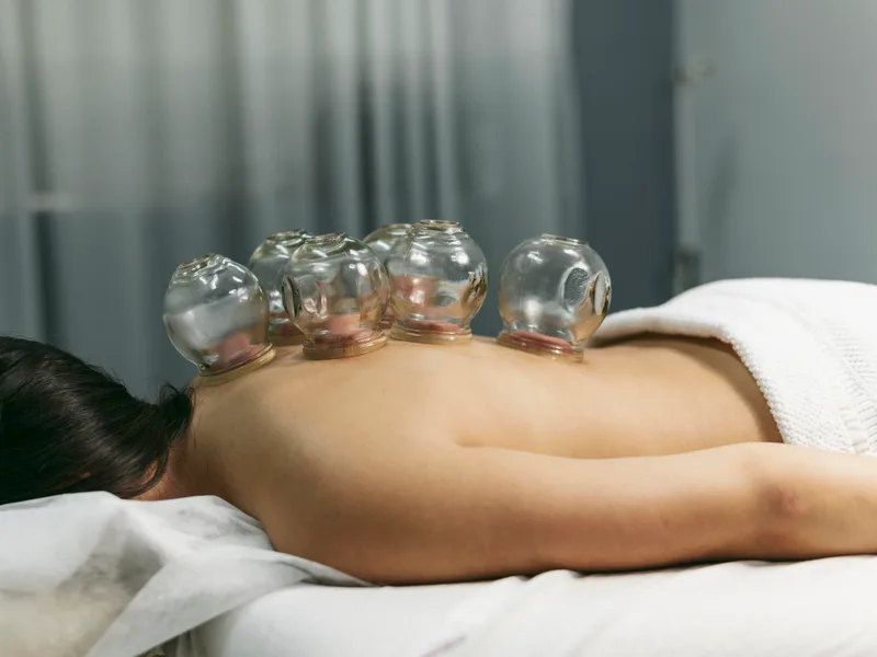 Cupping Therapy at New Beginnings Chiropractic in Hudsonville