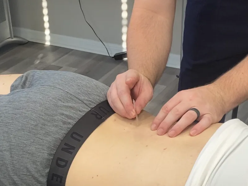 How Dry Needling works at New Beginnings Chiropractic