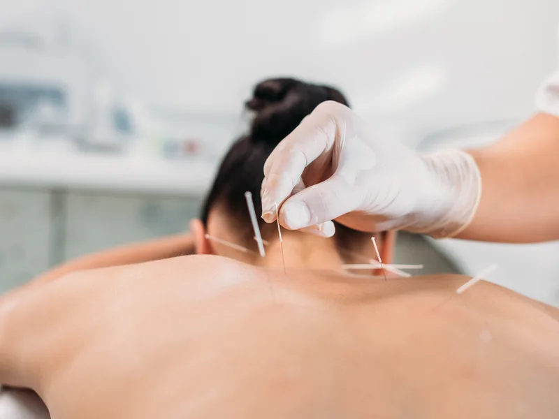 Dry Needling at New Beginnings Chiropractic in Hudsonville